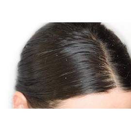 Aromatherapy Anti Dandruff Shampoo with Anti Dandruff Properties