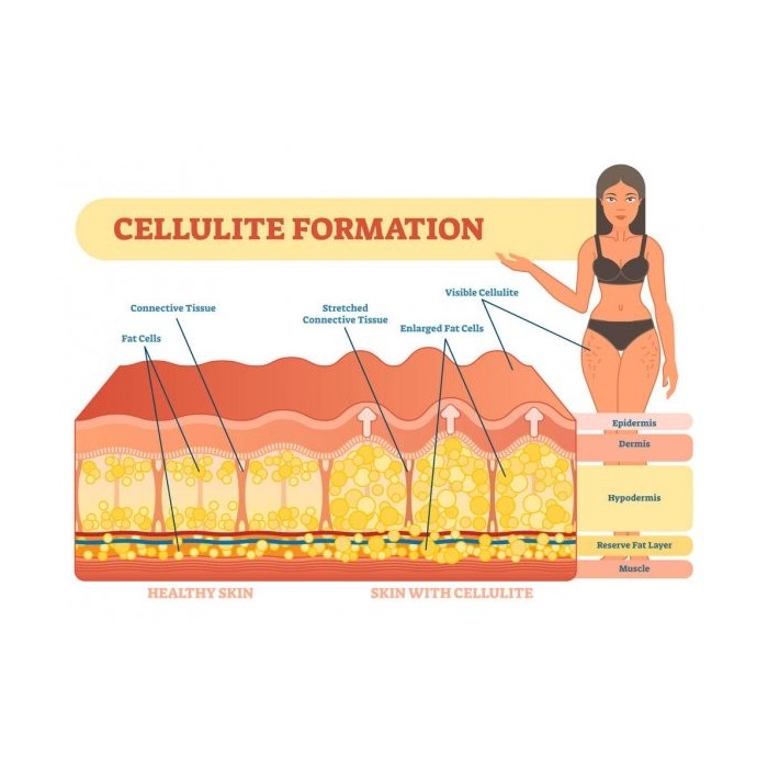 Anti Cellulite Gel - Weight loss , Fat Burning Gel