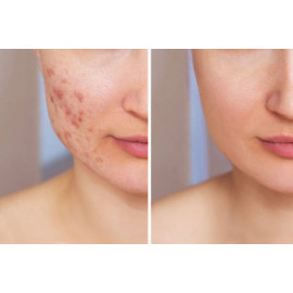 Essential Oils Blend for Acne 10 ml