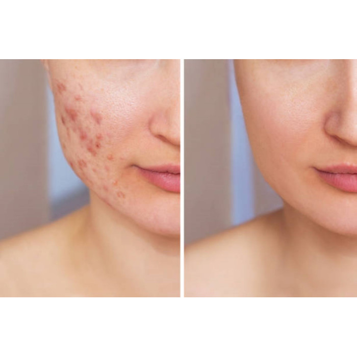 Essential Oils Blend for Acne 10 ml