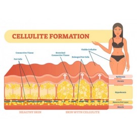 celulite skin and healthy skin