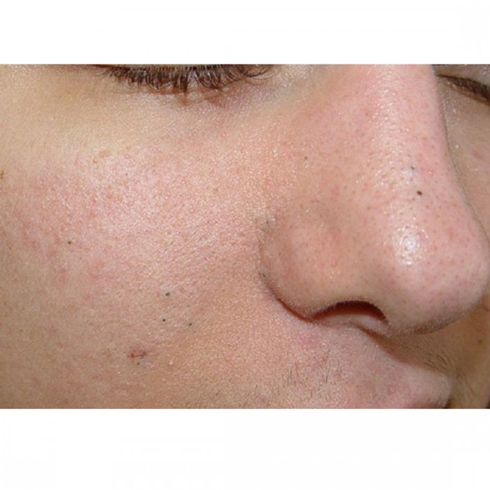 black-heads-cream-lifestyle-image