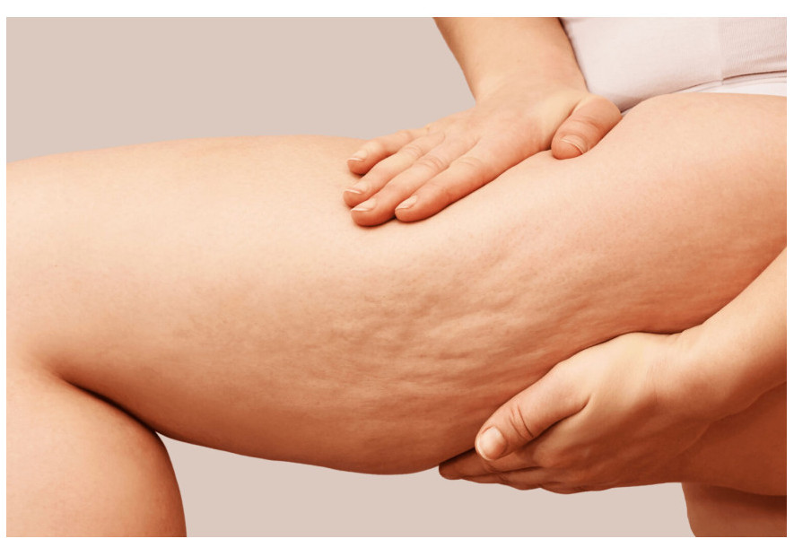 Ecoplanet Aromatherapy Massage Oil for Cellulite: Enhancing Your Skincare Routine Naturally