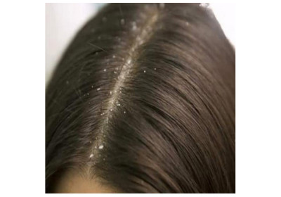 Aromatherapy for Dandruff