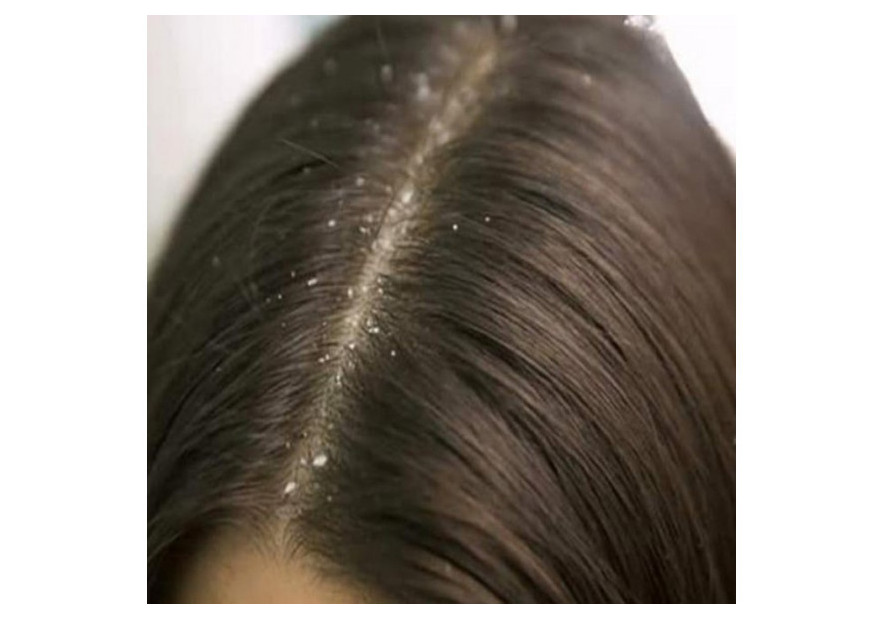 Aromatherapy for Dandruff