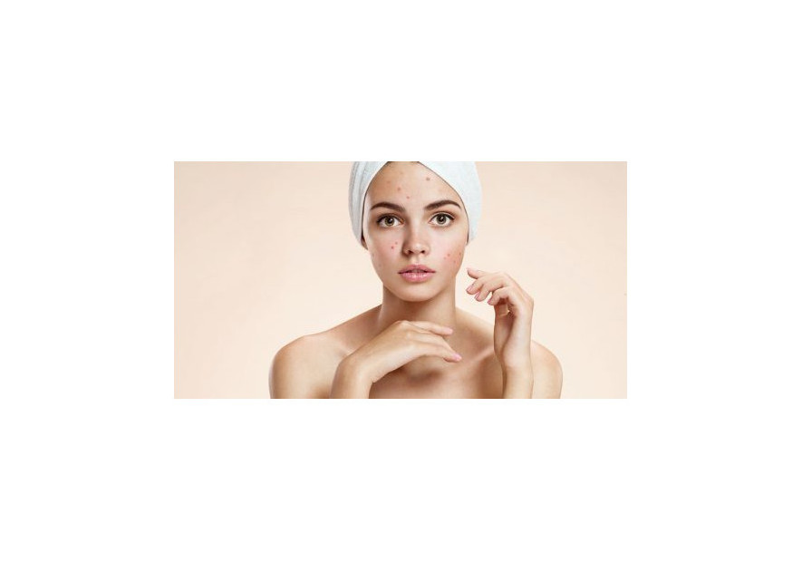 ACNE AND AROMATHERAPY FOR ACNE