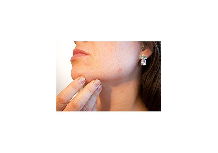 Benefits of Aromatherapy for Acne