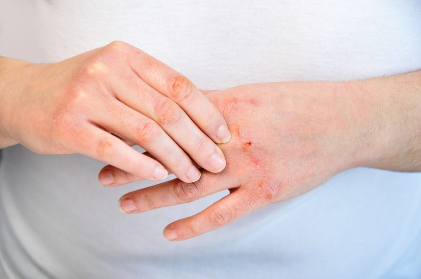 aromatherapy for dermatitis